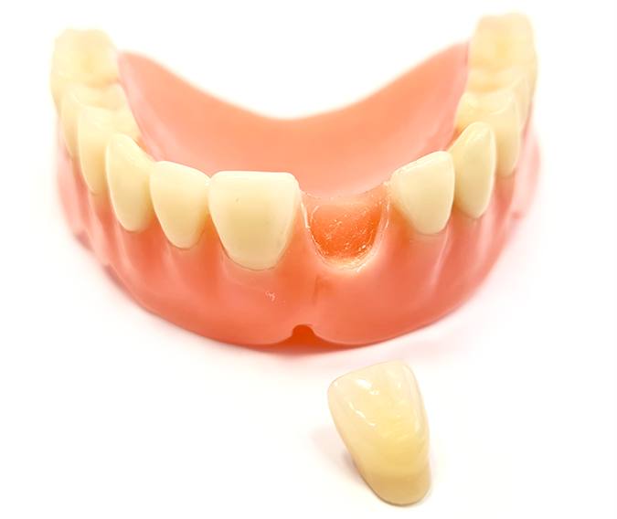 Izpadel ali odlomljen zob