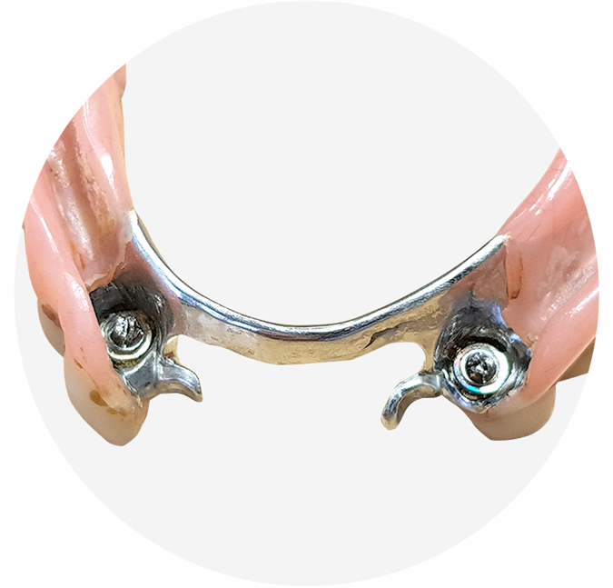 Menjava retencijskih elementov v protezi