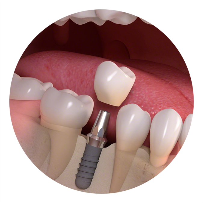 Cementirana implantatna prevleka