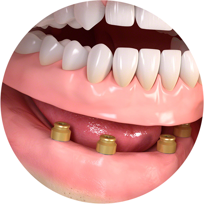 Implantatna proteza z LOCATORJI