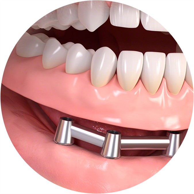 Implantatna proteza na gredi