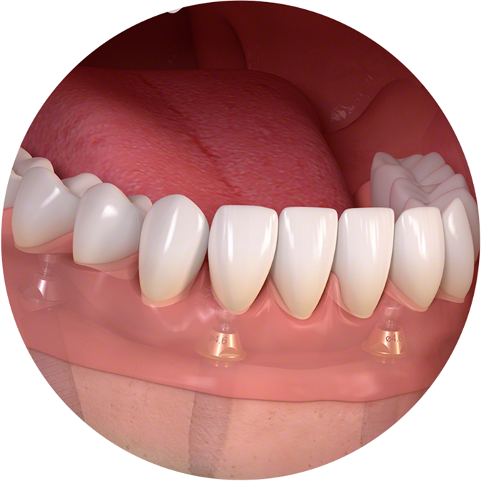 Implantatna proteza na teleskopih
