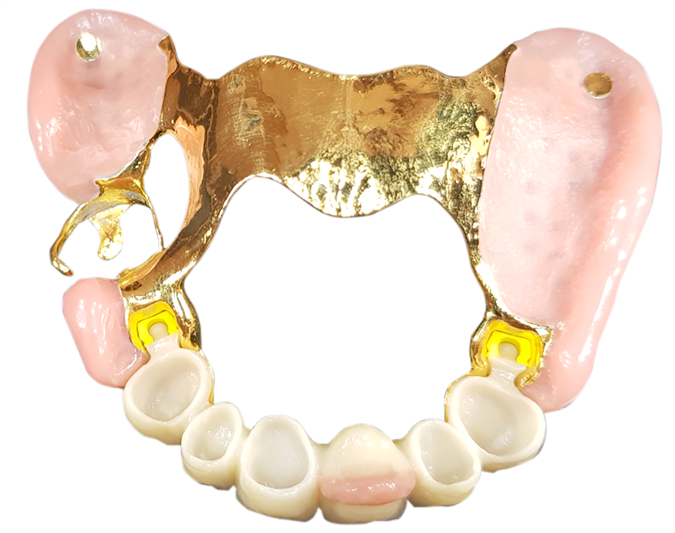 Delne proteze s skritimi retencijskimi elementi