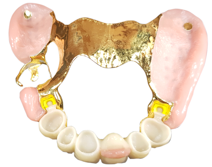 Delne proteze s skritimi retencijskimi elementi